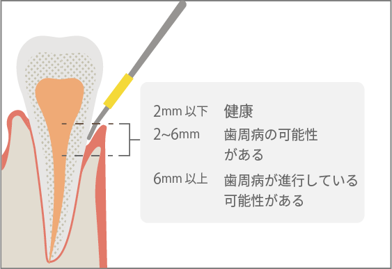 歯周ポケット検査イメージ